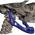 Вставлена первая напечатанная на 3D-принтере искусственная челюсть